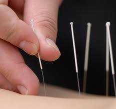Acupuncture and Cupping