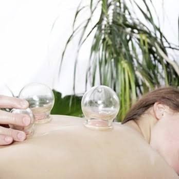 Acupuncture and Cupping