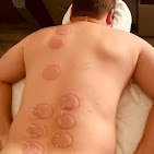 Redlands Family Acupuncture